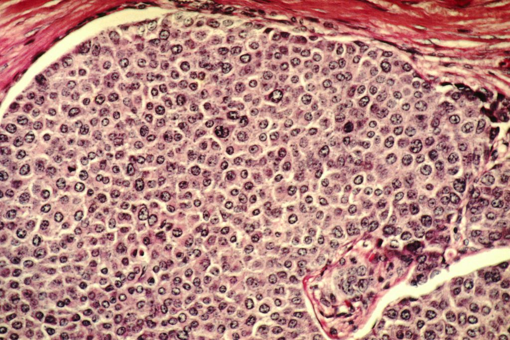 Breast_cancer_cells