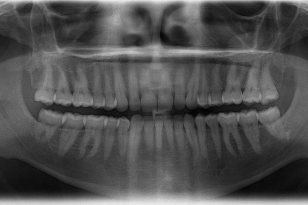 X-ray_of_all_32_human_teeth